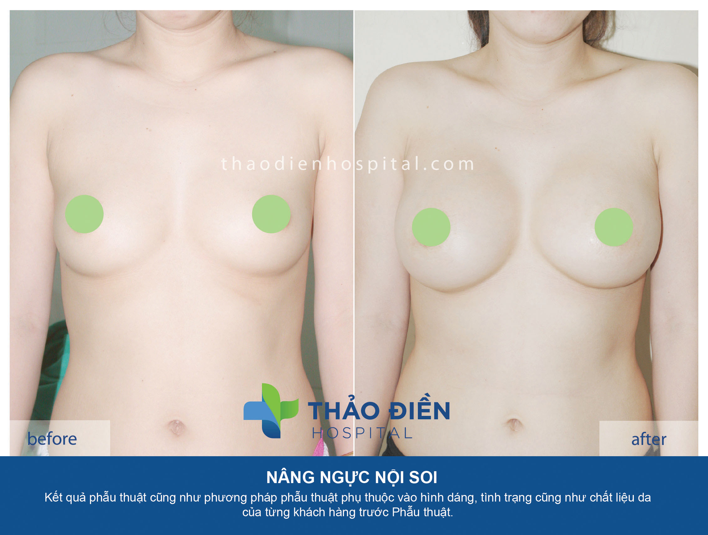 Nâng ngực nội soi đường nách - túi gel hình tròn 260cc