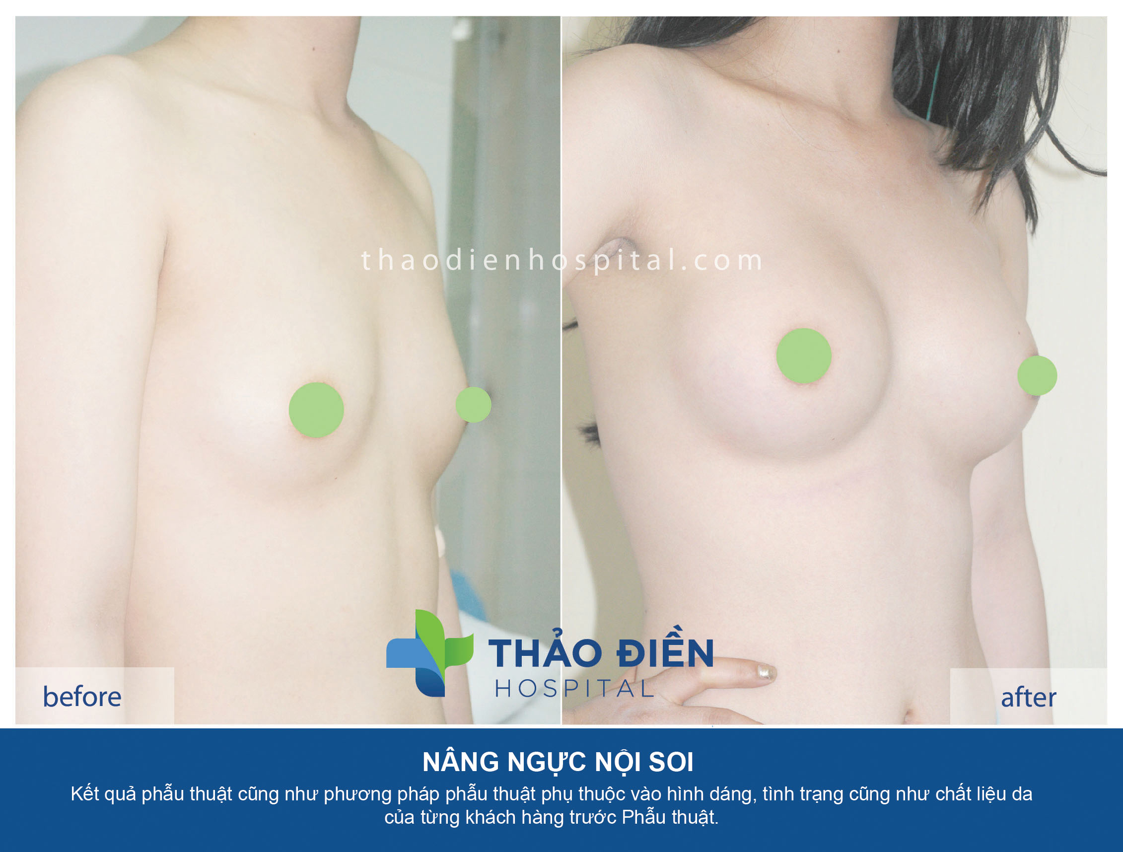 Nâng ngực nội soi đường nách - túi gel hình tròn 280cc