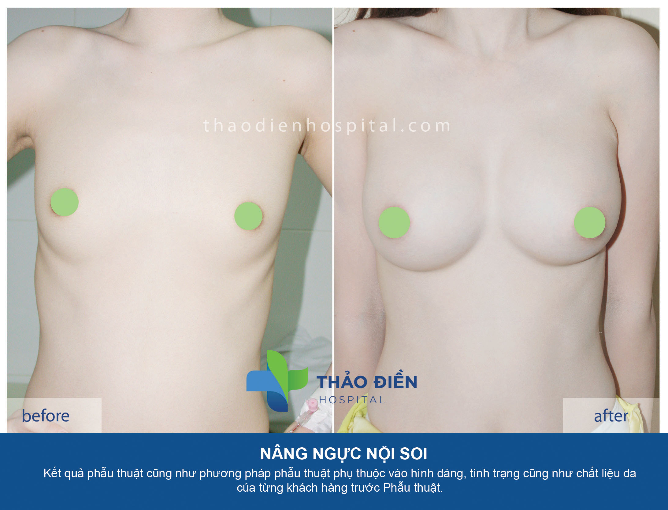 Nâng ngực nội soi đường nách - túi gel hình tròn