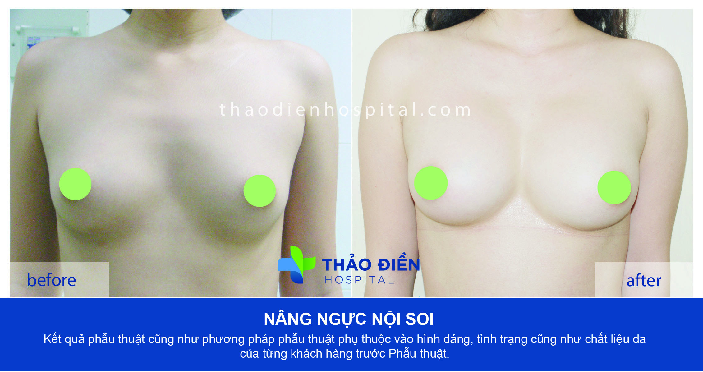 Nâng ngực nội soi đường nách - túi gel hình tròn 300cc