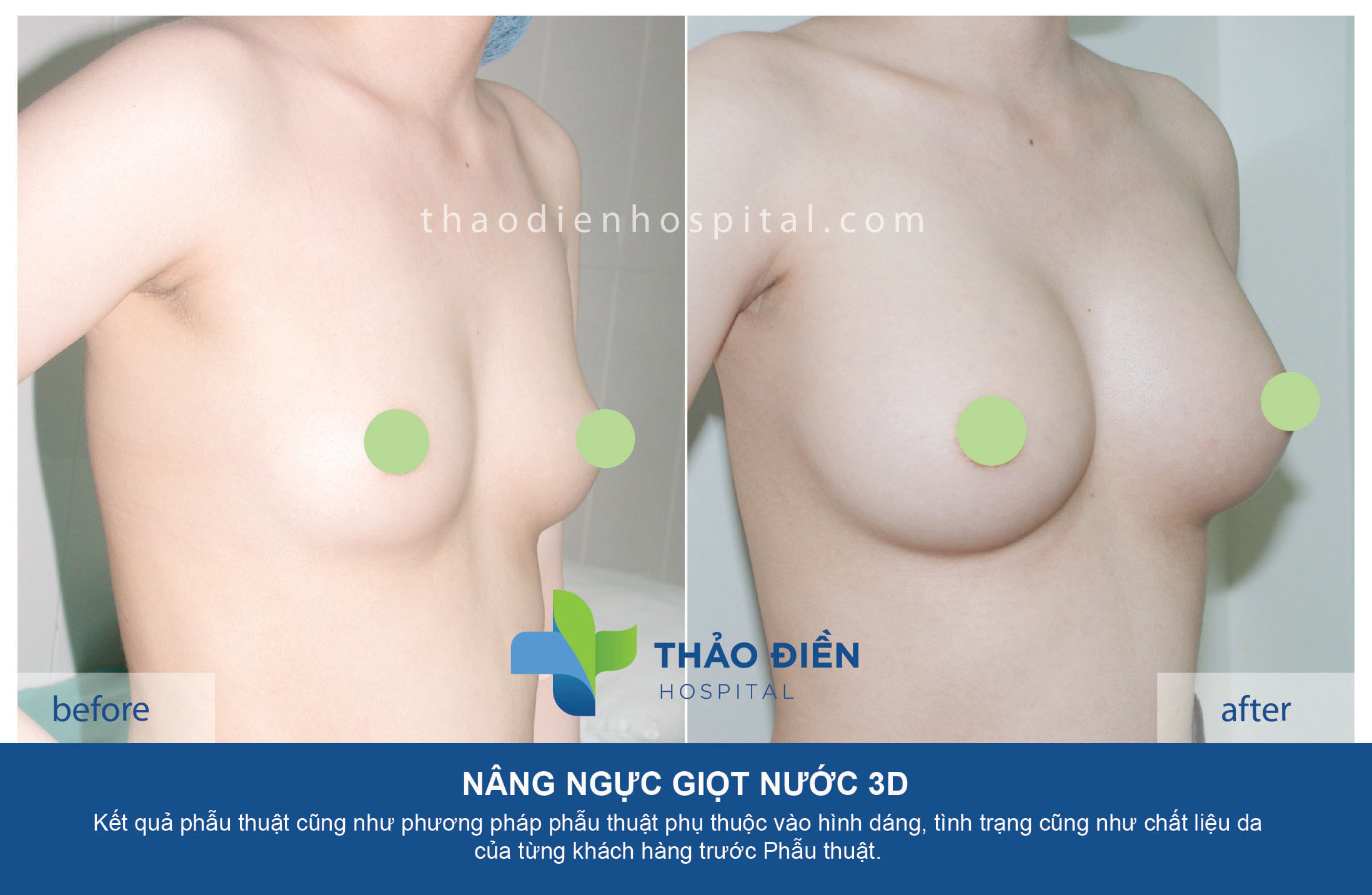 Nâng ngực 3D đường nách túi gel hình tròn 260cc