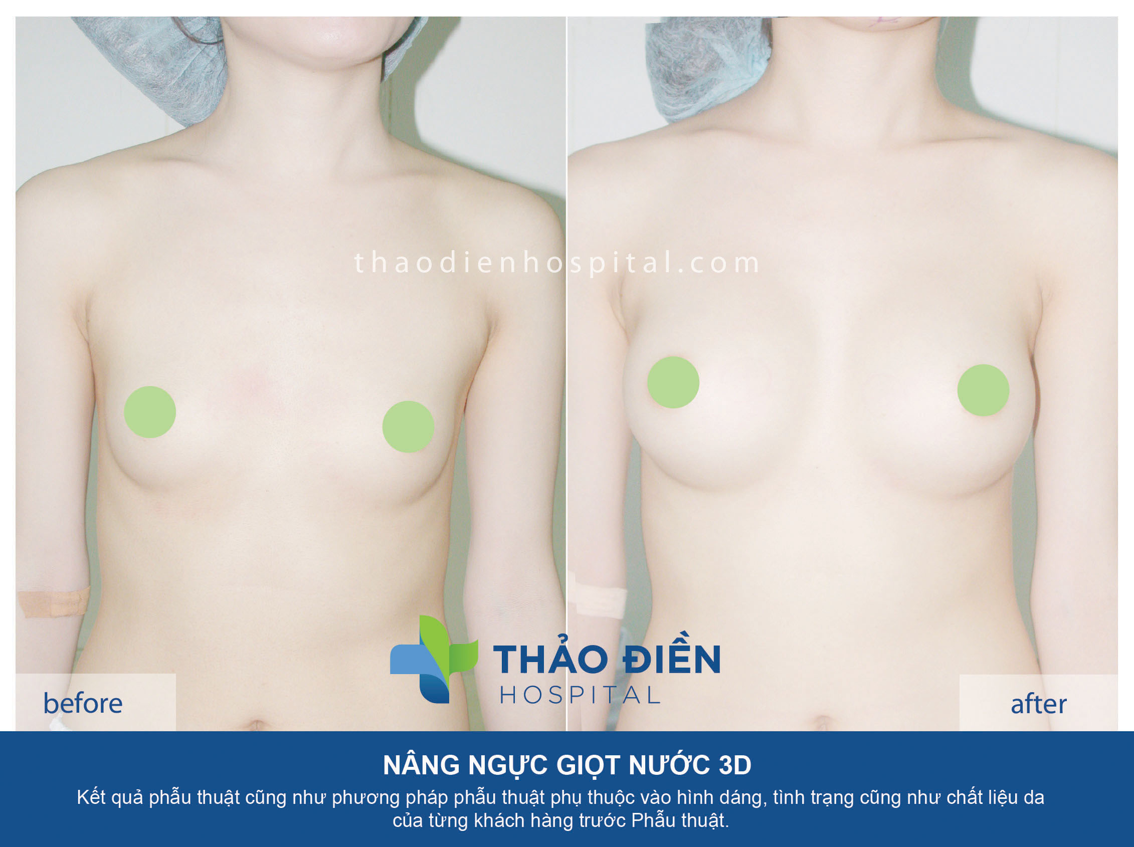 Nâng ngực 3d - túi gel hình tròn 300cc