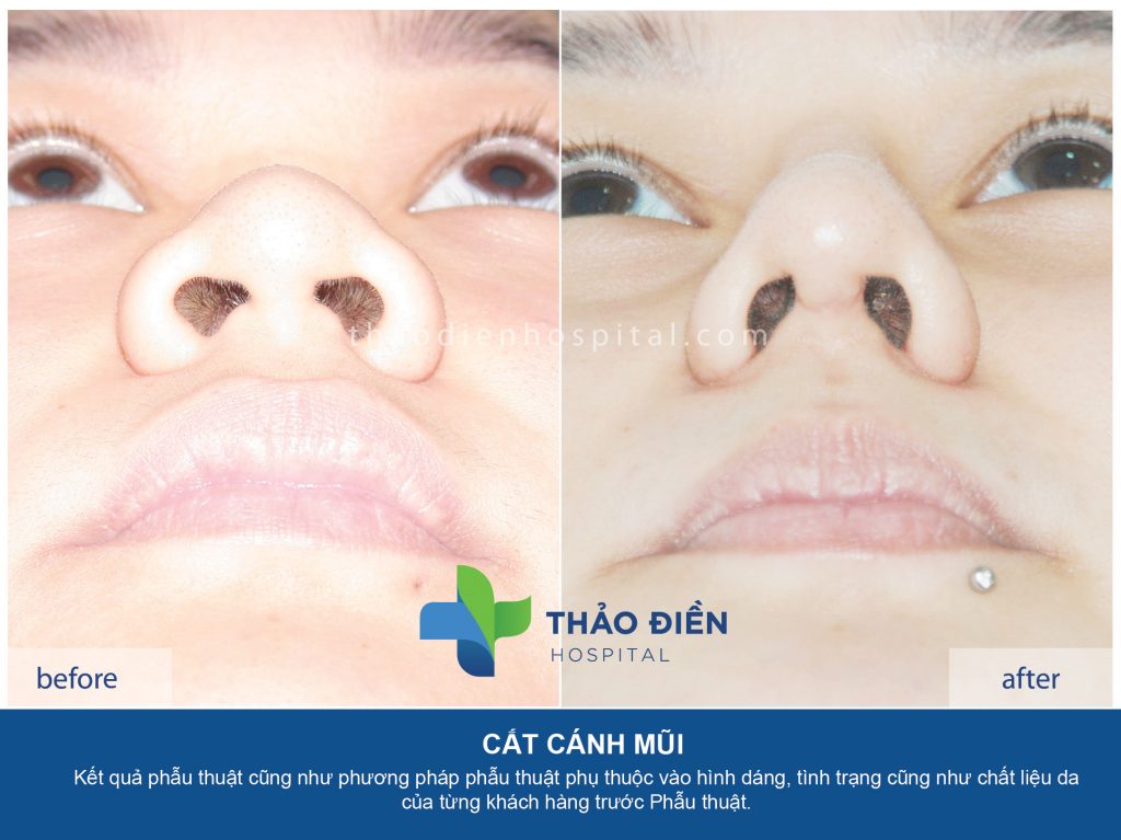 Cánh cánh mũi tại bệnh viện quốc tế Thảo Điền Kết quả phẫu thuật cũng như phương pháp phẫu thuật phụ thuộc vào hình dáng, tình trạng cũng như chất liệu da của mỗi Khách hàng trước Phẫu thuật