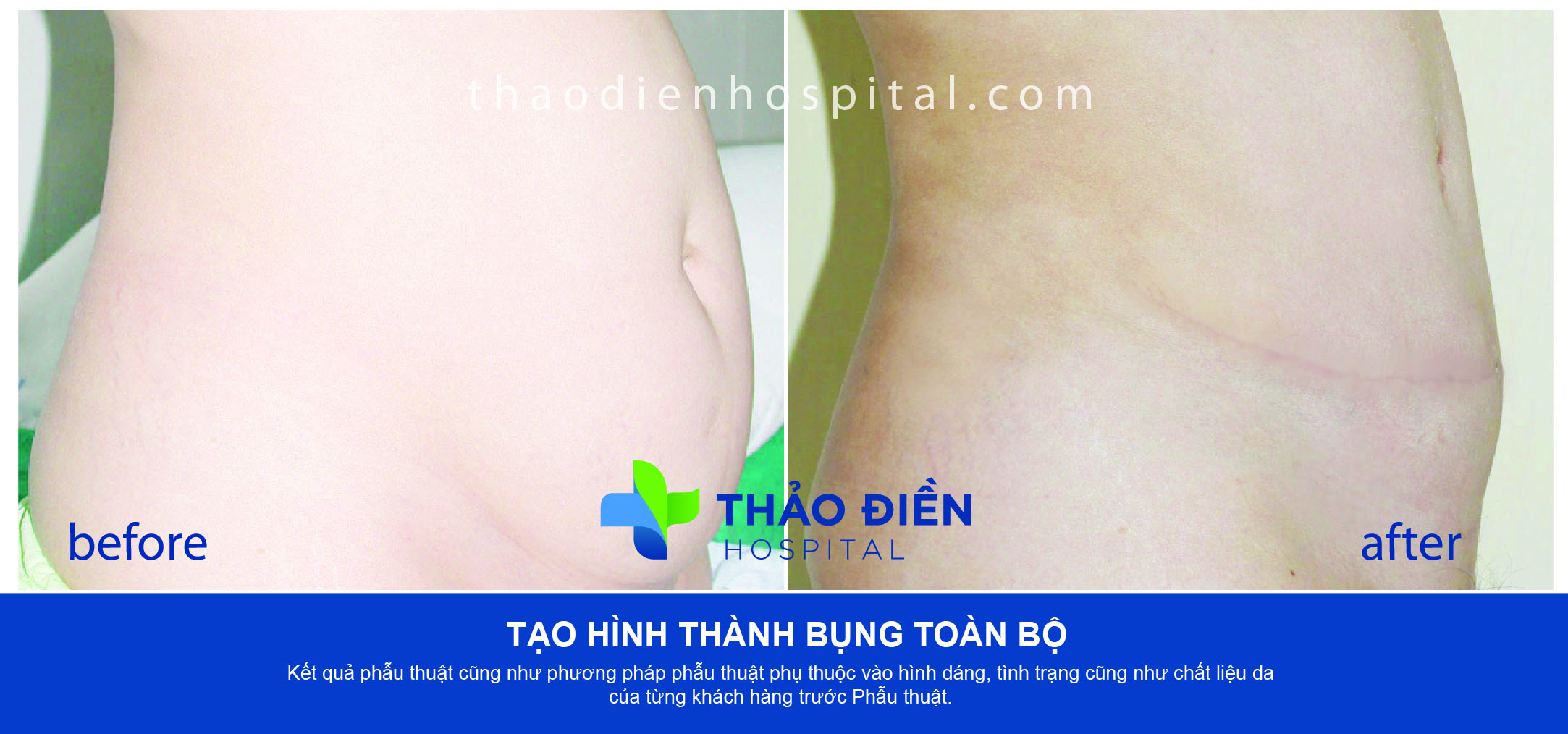 Tạo hình thành bụng toàn bộ